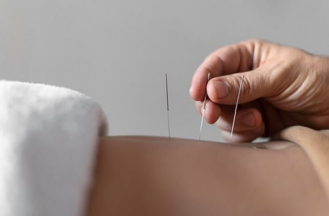 Acupuncture