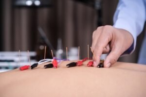 How Acupuncture Supports Wellness