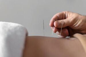 Acupuncture